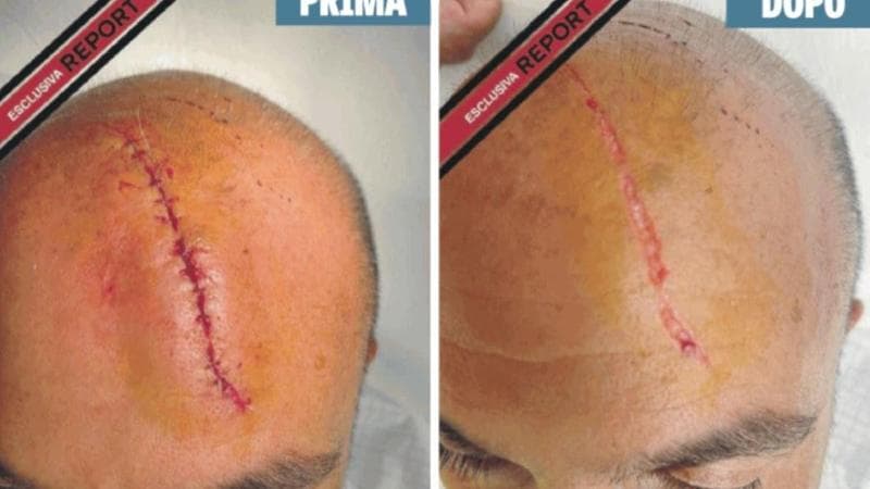 Sangiuliano-Boccia, a Report la foto della ferita alla testa. Questa sera su RaiTre anche l’inchiesta sul caso Spano