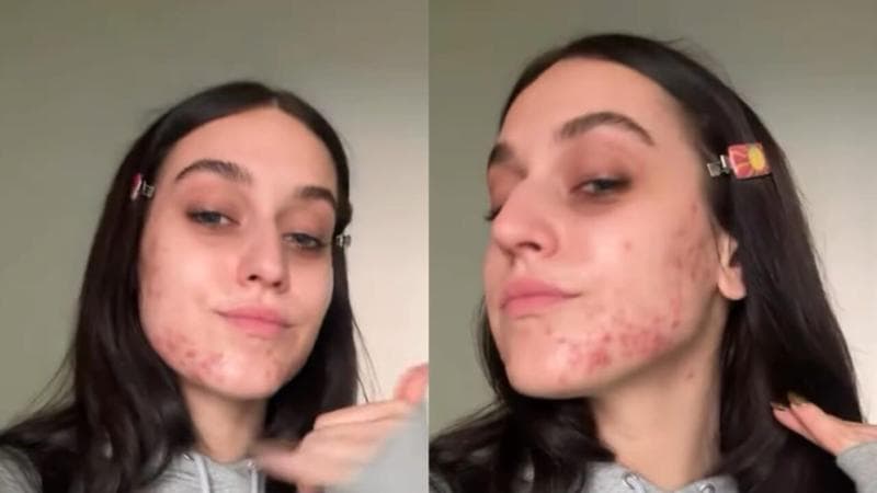 Gaia e l’acne: "Sto vivendo uno dei momenti più belli e mi ritrovo con la pelle che chiede aiuto”