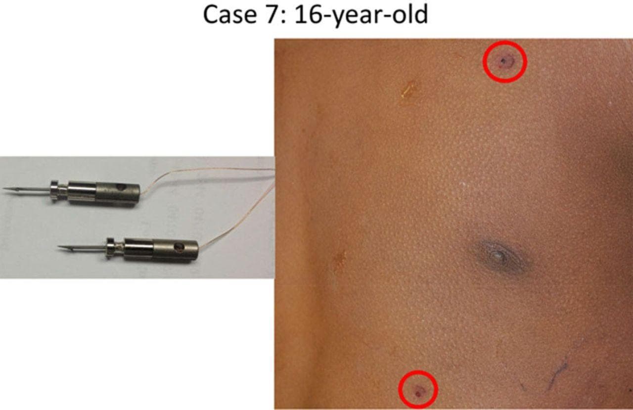 Le lesioni del taser vicino al cuore in uno dei casi studiati da Zipes