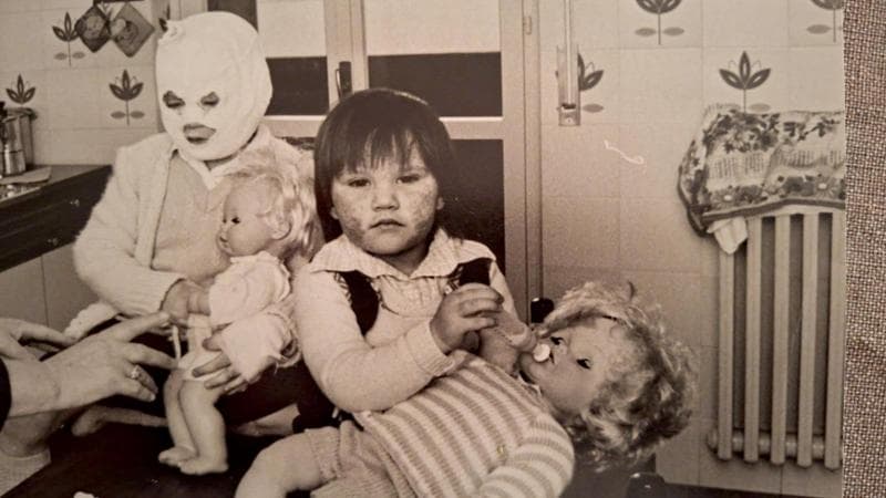 Stefania Senno a due anni e Alice (con il capo bendato) a quattro. per gentile concessione di stefania senno